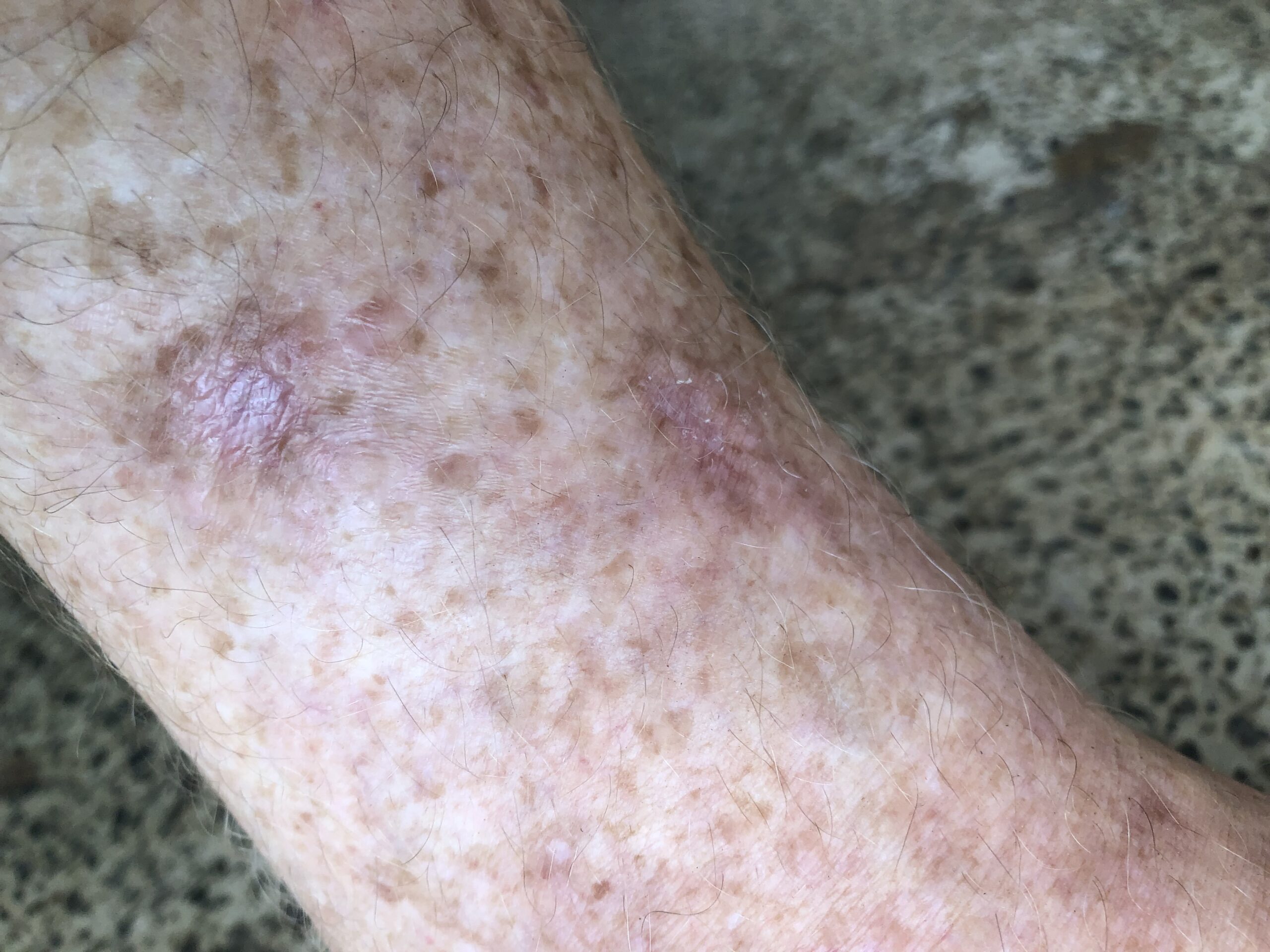 Wound nearly healed