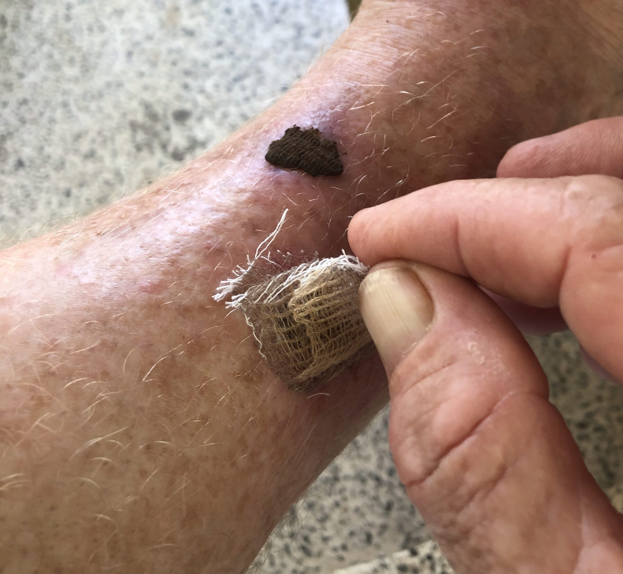 The lesion, detail view