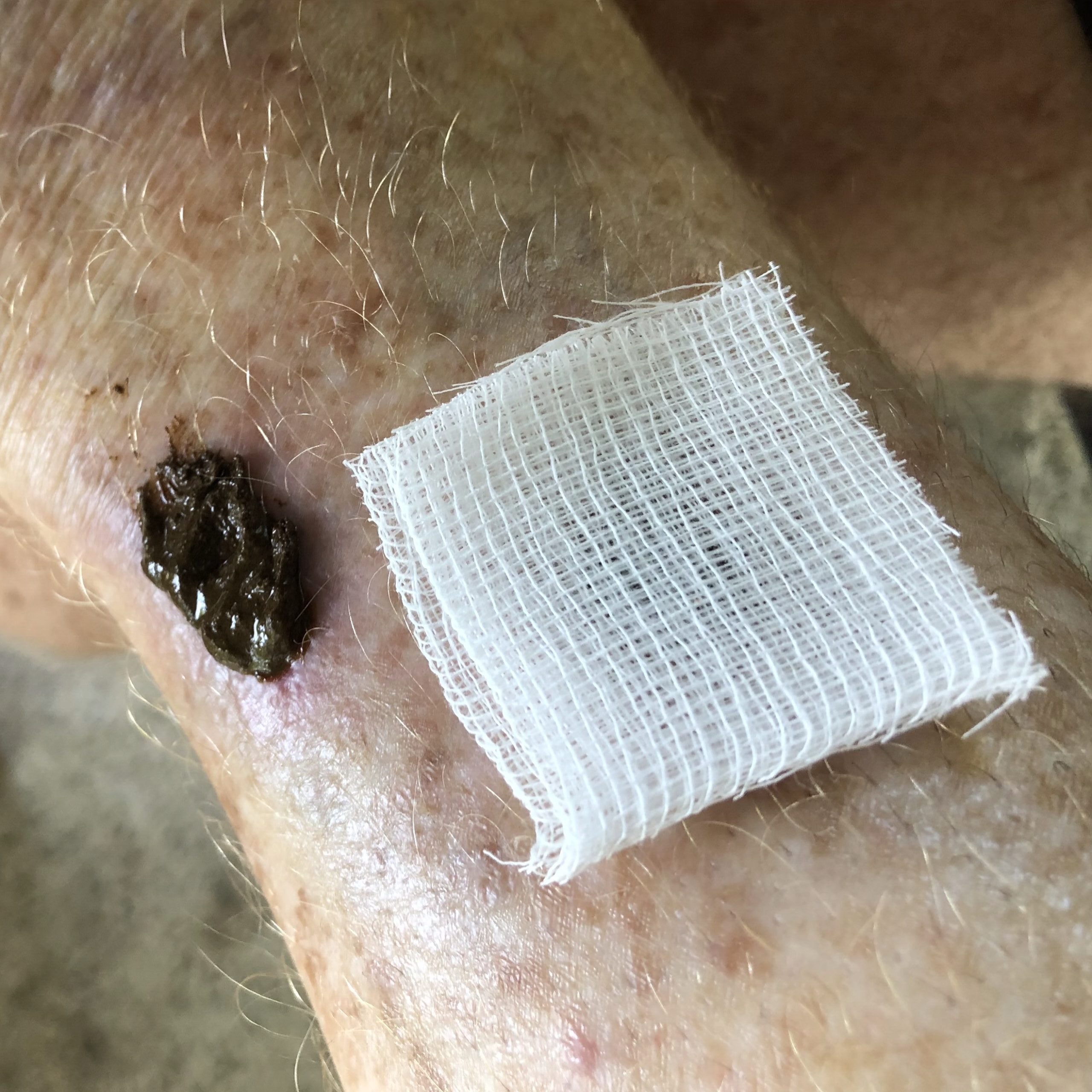 Wound during healing
