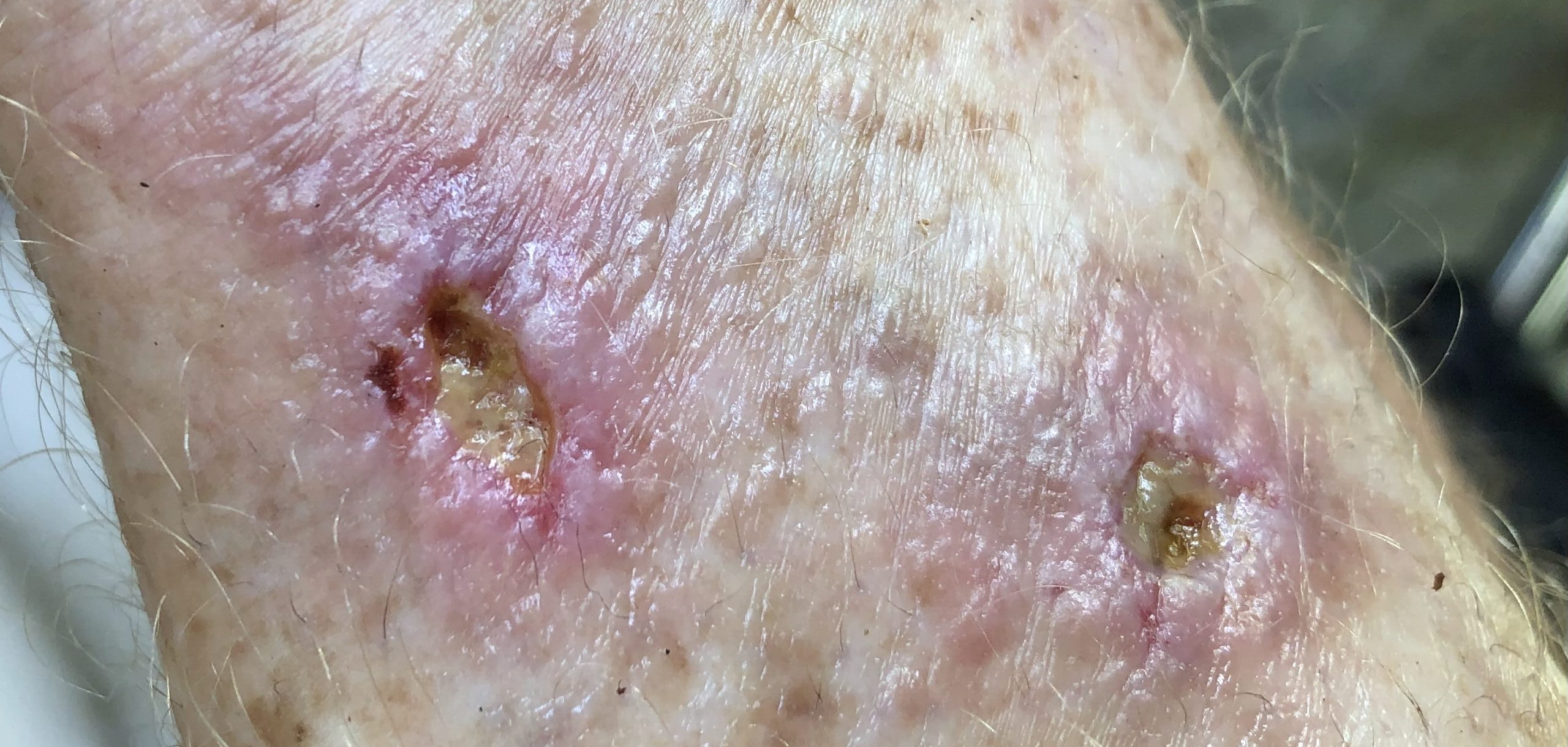 The wound, close view